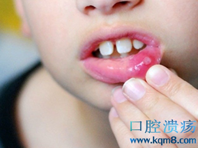 轻微口腔溃疡,口腔溃疡,疱疹样