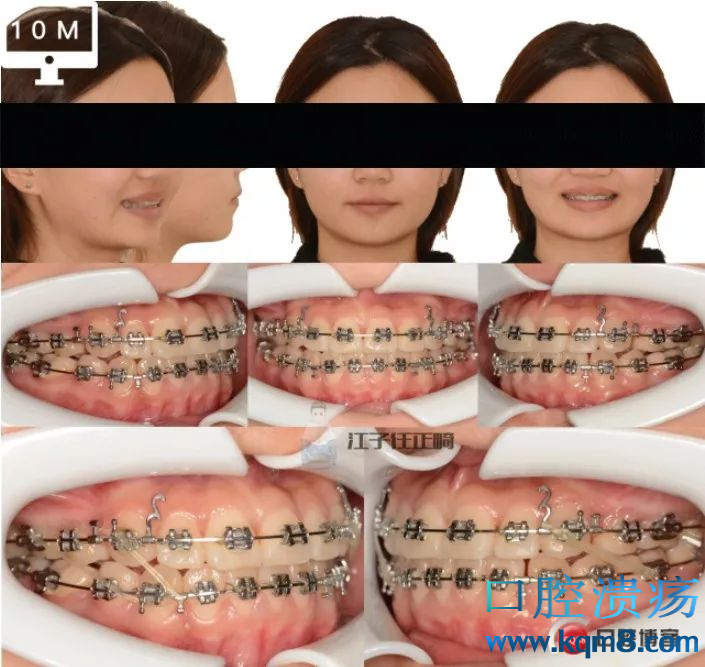 左侧二类牵引,右侧三类牵引(3/16兔子筋)