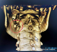 涎石症:小伙颌下疼痛难忍，原来舌头下长“石头”