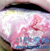 女子口腔溃疡反复3年 医院里检查后得割舌头