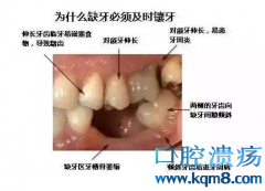 牙齿缺失不补牙都有哪些危害？