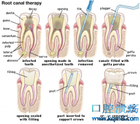 根管治疗是什么？