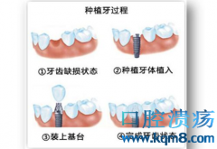 种植牙到底是怎么“种”的？