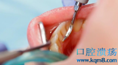 牙结石影响口腔健康吗?牙结石如何预防?