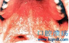 艾滋病症状：疱疹、口腔溃疡、咽喉肿痛、皮肤受损都是艾滋病常见的临床症状