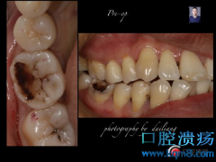 C6大面积龋齿缺损，聚合瓷嵌体修复