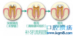 牙洞越补越大怎么办？请使用嵌体补牙