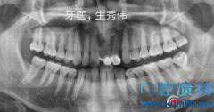 种植牙齿需要多长时间恢复？