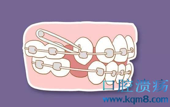 \"口腔正畸：为什么有些人要进行二次牙齿矫正？\"