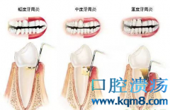 牙周病的危害及牙周病的早期症状