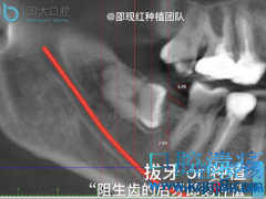 拔牙 or 种植 阻生齿的后牙即刻种植