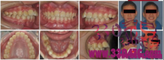 舌侧活动翼矫治技术——临床病例