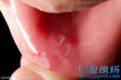 宝宝口腔溃疡如何进行食物调理？