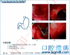 第一次无痛胃肠镜检查过程