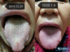 口腔溃疡几年中医治疗验案1例
