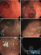 上消化道肿瘤内镜治疗策略系列之伴有溃疡疤痕的早期胃癌