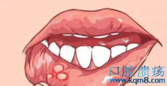 口腔溃疡发病原因是脾虚上火？