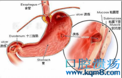 内科--消化性溃疡