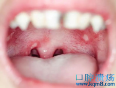 口腔溃疡反复发作，可能与这几个误区有关