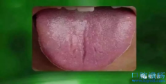 舌上的裂纹，就是肾中的火焰！中医治疗舌裂纹的医案