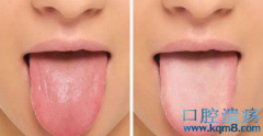 舌头疼别不当回事，舌炎的早期症状要知道！