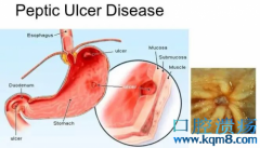 消化性溃疡是怎么来的？