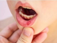 口腔溃疡很烦人怎么治疗？