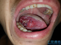 口腔溃疡长期不愈，一查竟然是口腔癌！