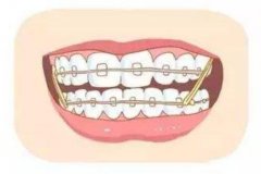 牙齿矫正时间久吗 一般多大年纪适合牙齿矫正