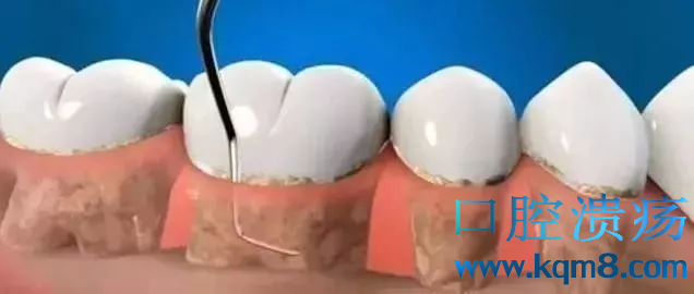 牙龈下面的牙结石怎么处理?