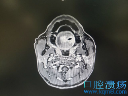 舌头莫名长肿物疑肿瘤舌癌，检查才知竟是鱼刺插入舌头？