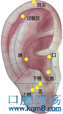 用耳针治疗口腔溃疡方法