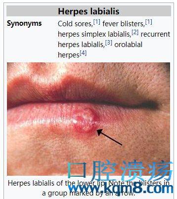 嘴上有“唇疱疹”就别乱亲宝宝了，那不是上火是单纯疱疹病毒/HSV的病毒