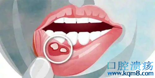 口腔溃疡反复发作会口腔癌是真的吗？