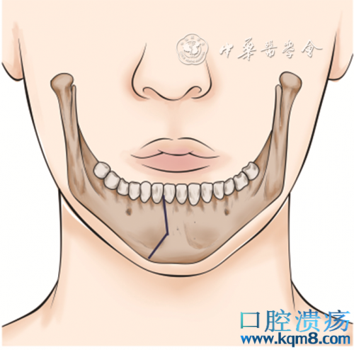 舌黏膜鳞状细胞癌外科治疗