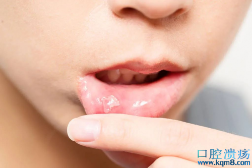 口腔溃疡复发就是口腔扁平苔藓吗？